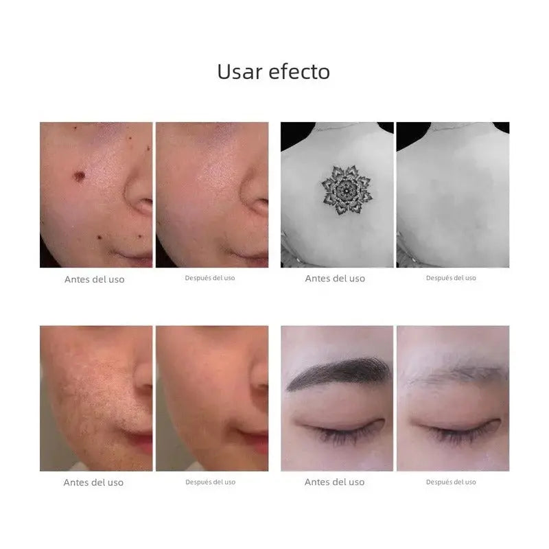 Lápiz Laser Picosegundos Luz Azul. Manchas, Tatuajes Y Mas. thor insumos